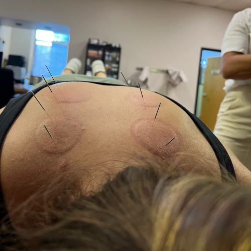 acupuncture-2-Jennifer-Scherbauer-DC-ND-LLC-chicago-il