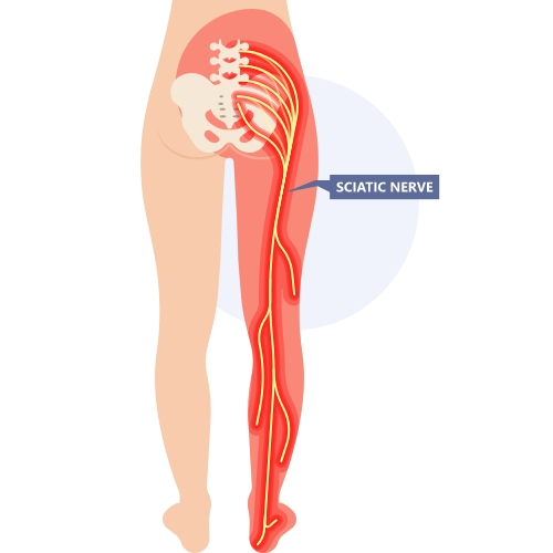 sciatica-Jennifer-DC-ND-LLC-cihiropractor-chicago-il