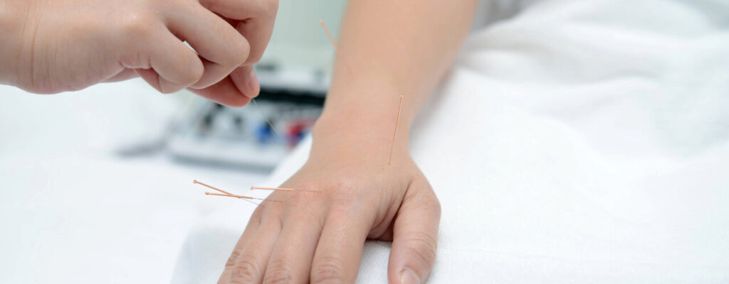 What to Expect During Your First Acupuncture Session